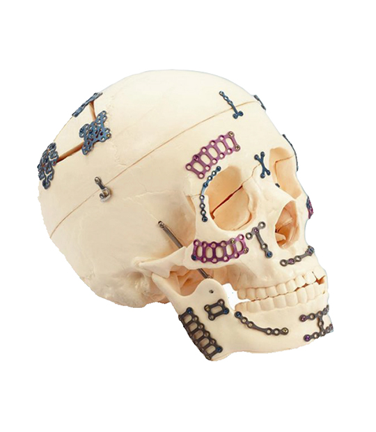 Maxillofacial (CMF) Implants